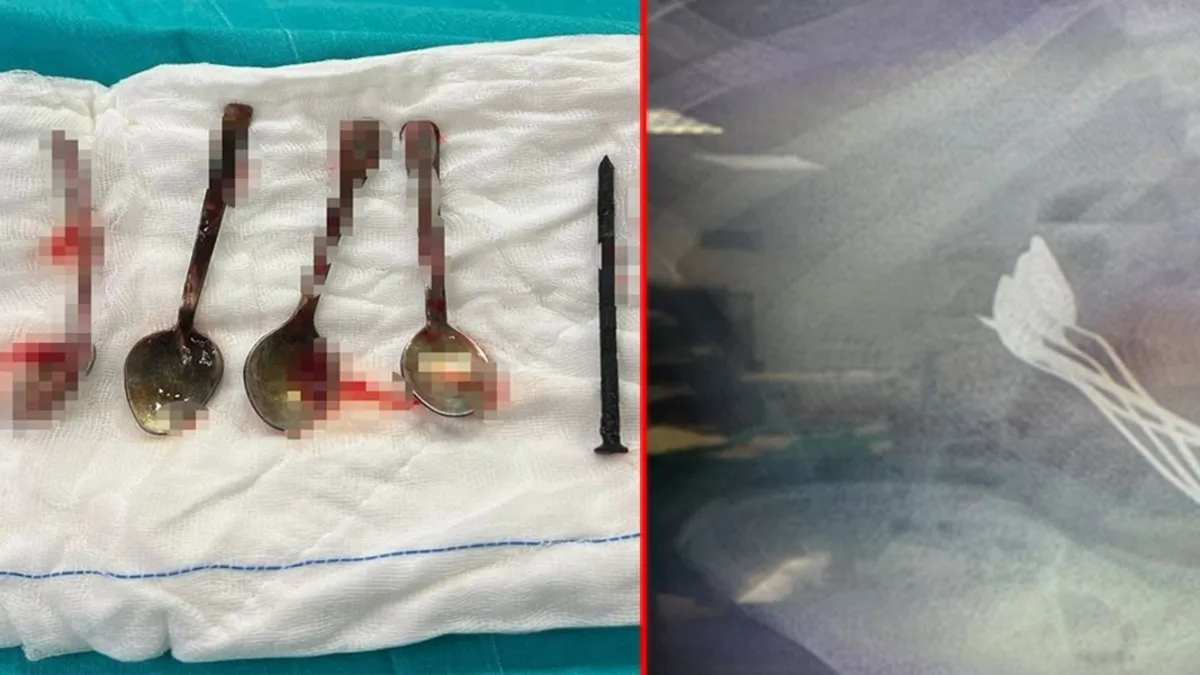 Kayseri’de akılalmaz olay: Doktorlar şaşkına döndü! Hepsi 15 yaşındaki çocuğun midesinden çıktı